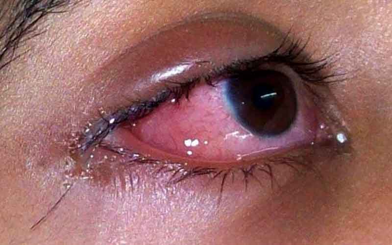 EYEFLU.jpg